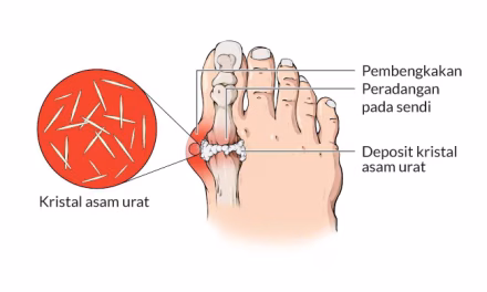 Asam Urat: Penyebab, Gejala, Dan Pantangan Makanan