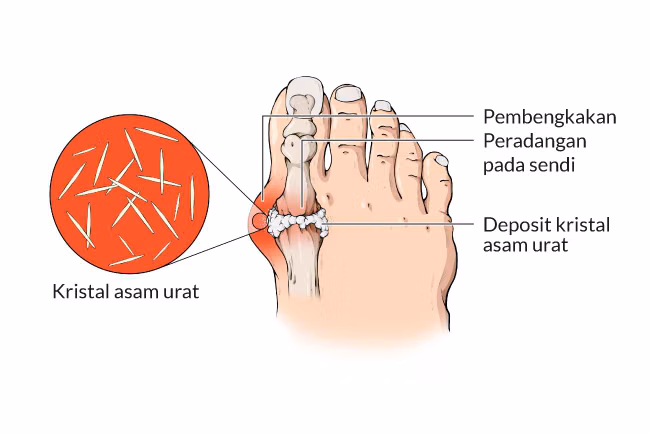 Asam Urat: Penyebab, Gejala, Dan Pantangan Makanan